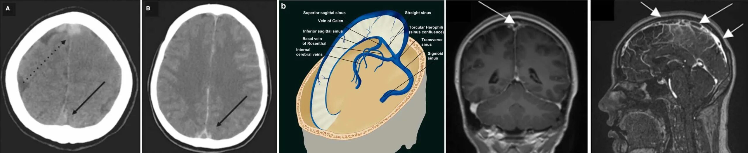 Поперечный синус головного мозга на кт. Тромбоз синусов головного мозга кт. Тромбоз венозного синуса головного мозга кт. Мрт тромбоз