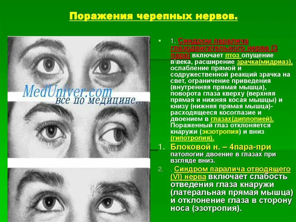 Нарушение движения глаз. Птоз,наружная офтальмоплегия. Парез отводящего нерва сходящееся косоглазие. Птоз и глазодвигательный нерв. Неврит глазодвигательного нерва.