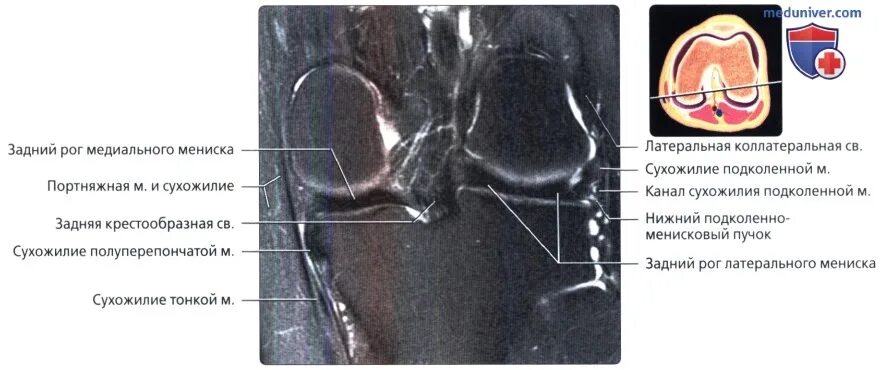 Разрыв рога медиального мениска коленного сустава заднего. Разрыв заднего рога мениска. Мышцы коленного сустава мрт анатомия. Повреждение заднего рога медиального мениска.