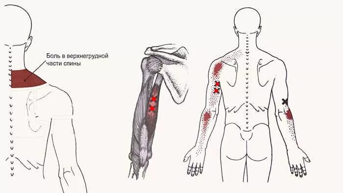 Триггерные точки поясницы. Триггерные точки боль мышцы спины. Триггерные точки на спине. Лестничные мышцы триггерные точки.