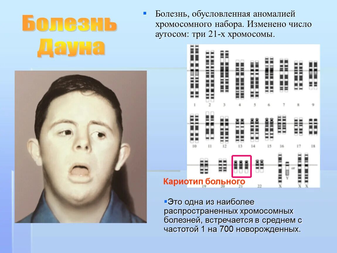 Болезнь Дауна хромосомный набор. Болезнь Дауна хромосомы. Болезнь Дауна набор хромосом. Хромосомные болезни аномалии аутосом.