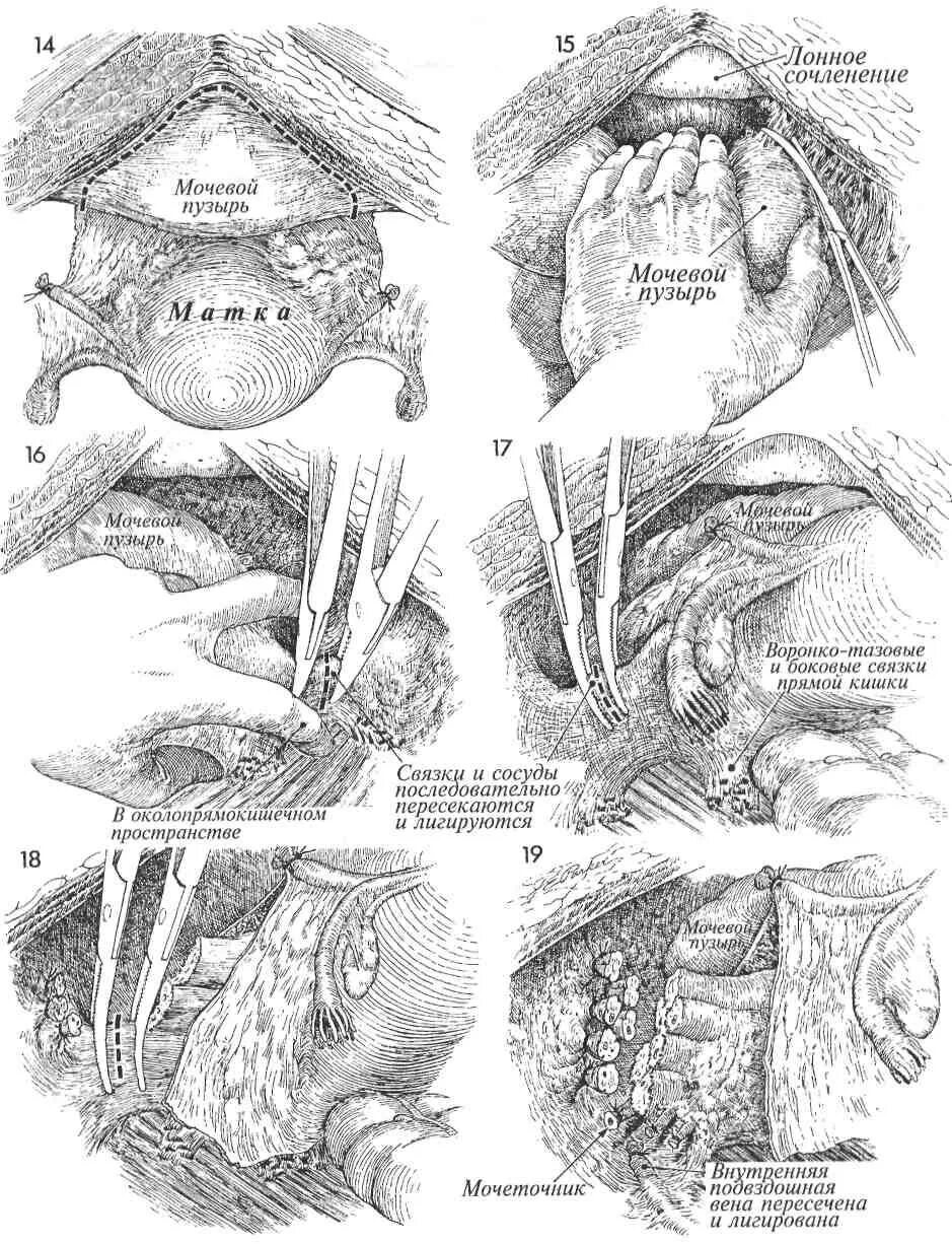 Какие связки матки. Связочный аппарат малого таза. Воронко-тазовая связка анатомия. Передняя эвисцерация малого таза. Связочный аппарат мочевого пузыря.