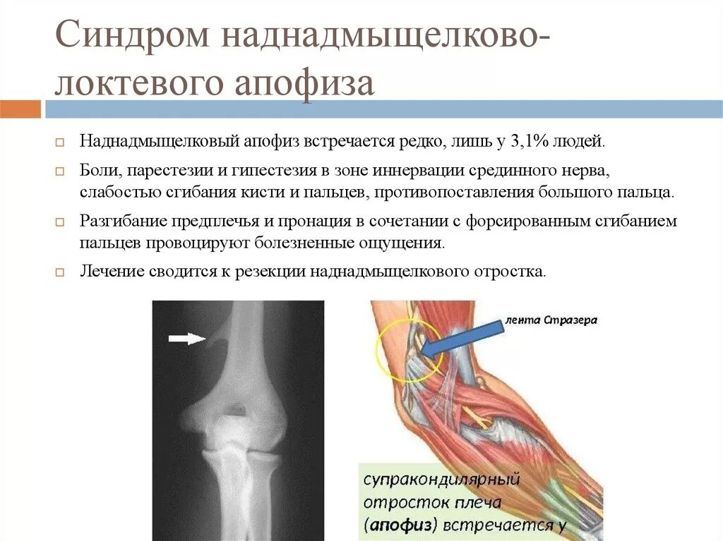 Кубитальный туннельный синдром локтевого нерва. Туннельный синдром предплечья. Туннельный синдром компрессии локтевого нерва. Туннельный синдром лучевого нерва.