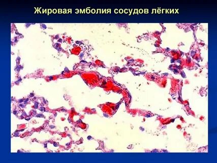 Жировой эмболии