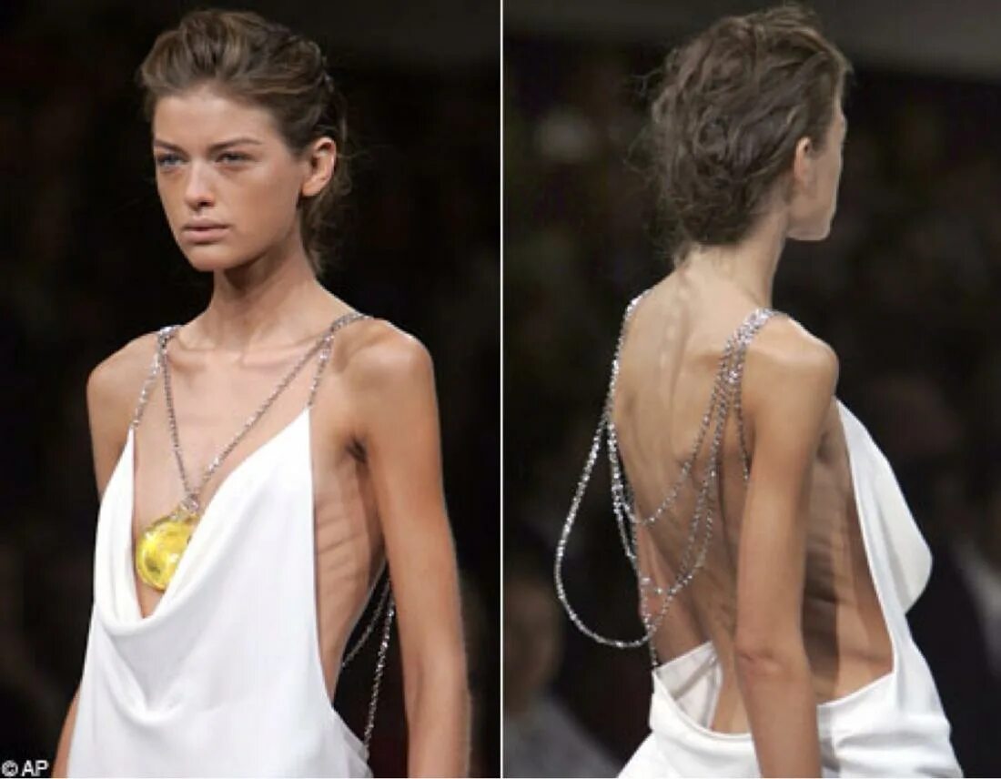 Худой девушки мире. Луисель рамос анорексия. Стефани скинни. Худой девушки мире. Худенькие девушки в купальниках.