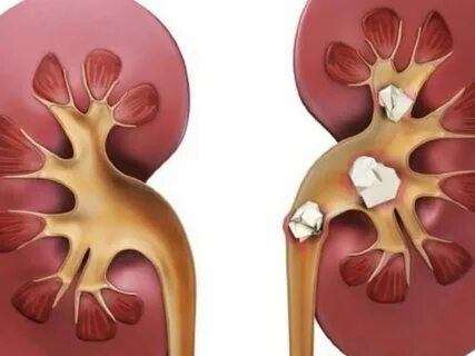 Лечение мочекаменной болезни пшеном - Как при помощи обычного пшена избавиться о