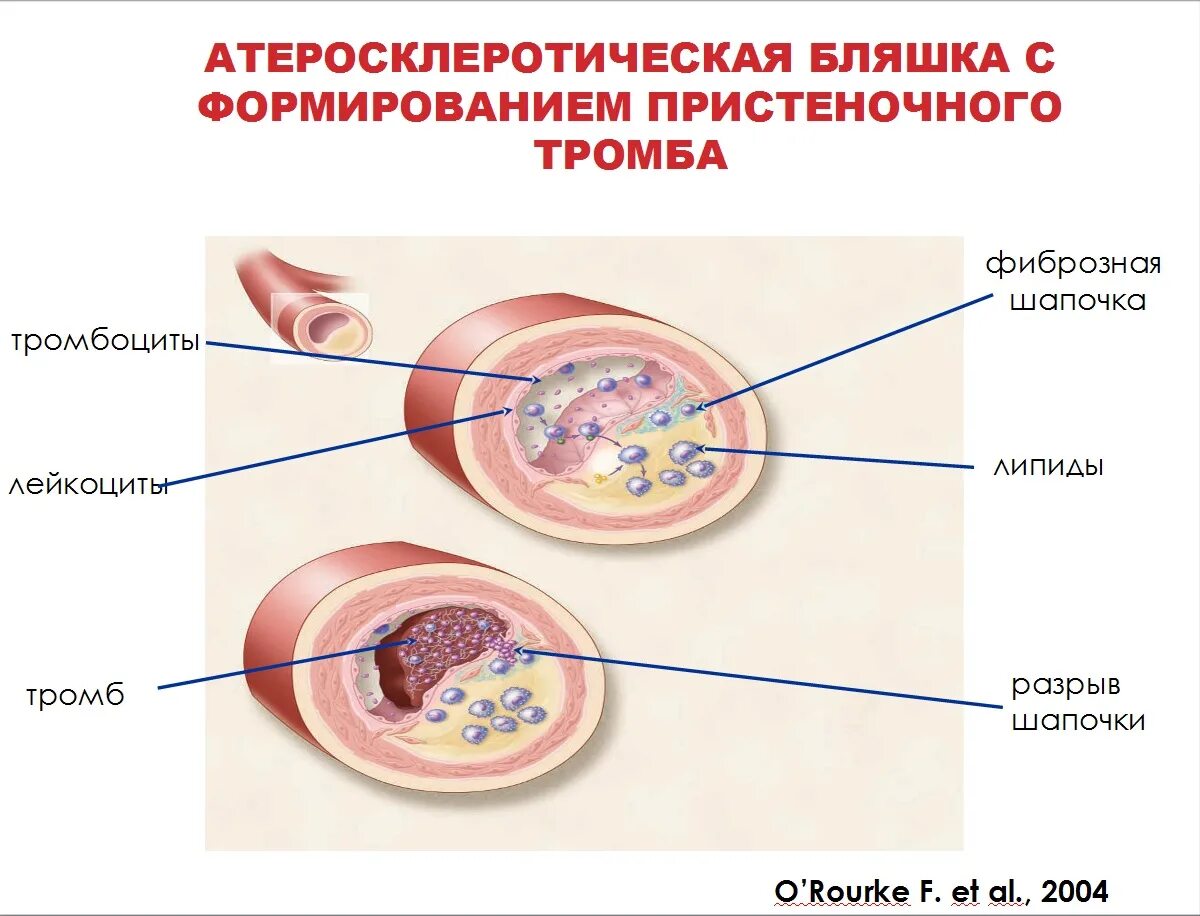 Атеросклеротическая бляшка. Атероклефическвя бляшка. Атеросклеротические бляшки формируются в. Кровоизлияние в атеросклеротическую бляшку. Тромб и бляшка разница