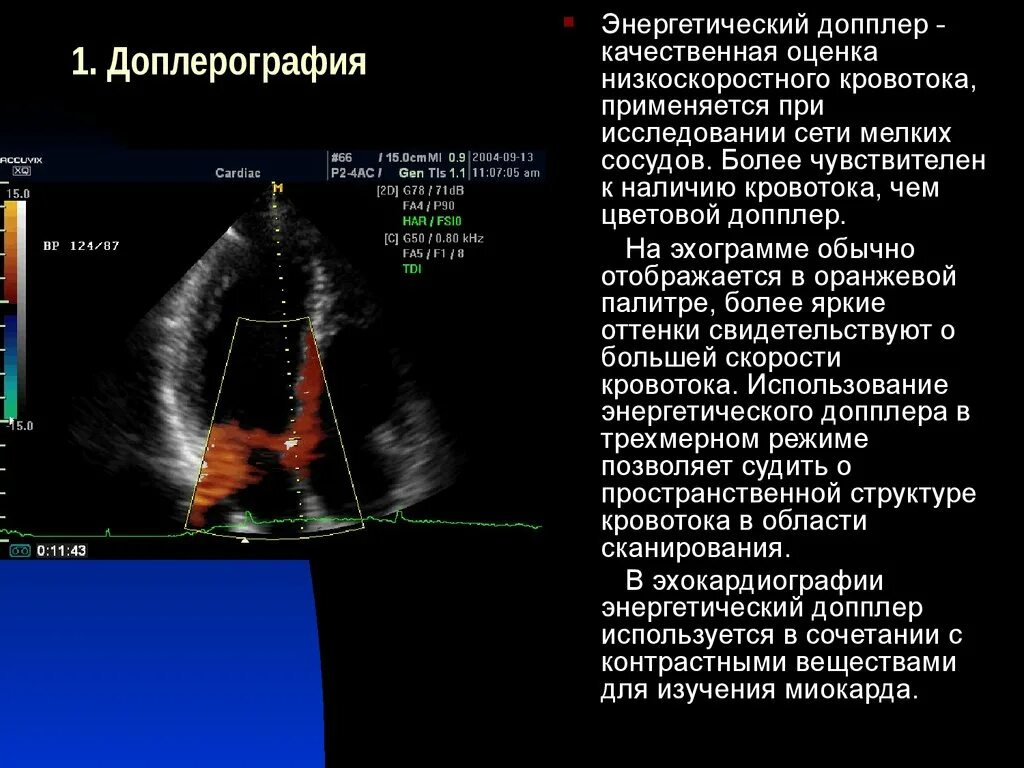 Доплер артерий. Исследование кровотока – допплер сердца. Допплер ЭХОКГ сердца. Цветной допплер УЗИ сердца.