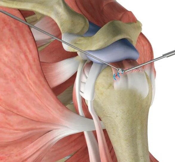 Травма связок сустава. Ротаторная манжета плечевого сустава анатомия. Ротаторная манжета плечевого сустава мышцы. Разрыв ротаторной манжеты плечевого сустава. Оссифицирующий тендинит.