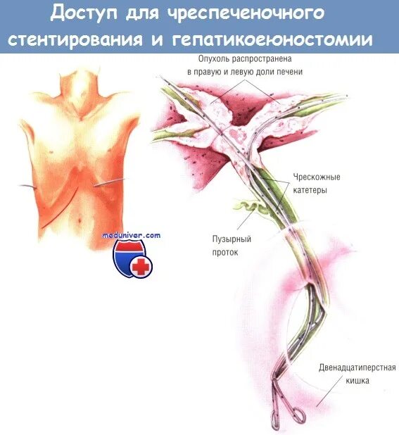 Стент желчного протока