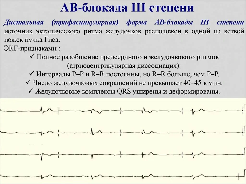 Са блокада 1 степени. Блокада са узла ЭКГ. Са блокада 2 степени 2 типа на ЭКГ. Синоатриальная блокада 3 степени. Механизм развития АВ блокады 3 степени.