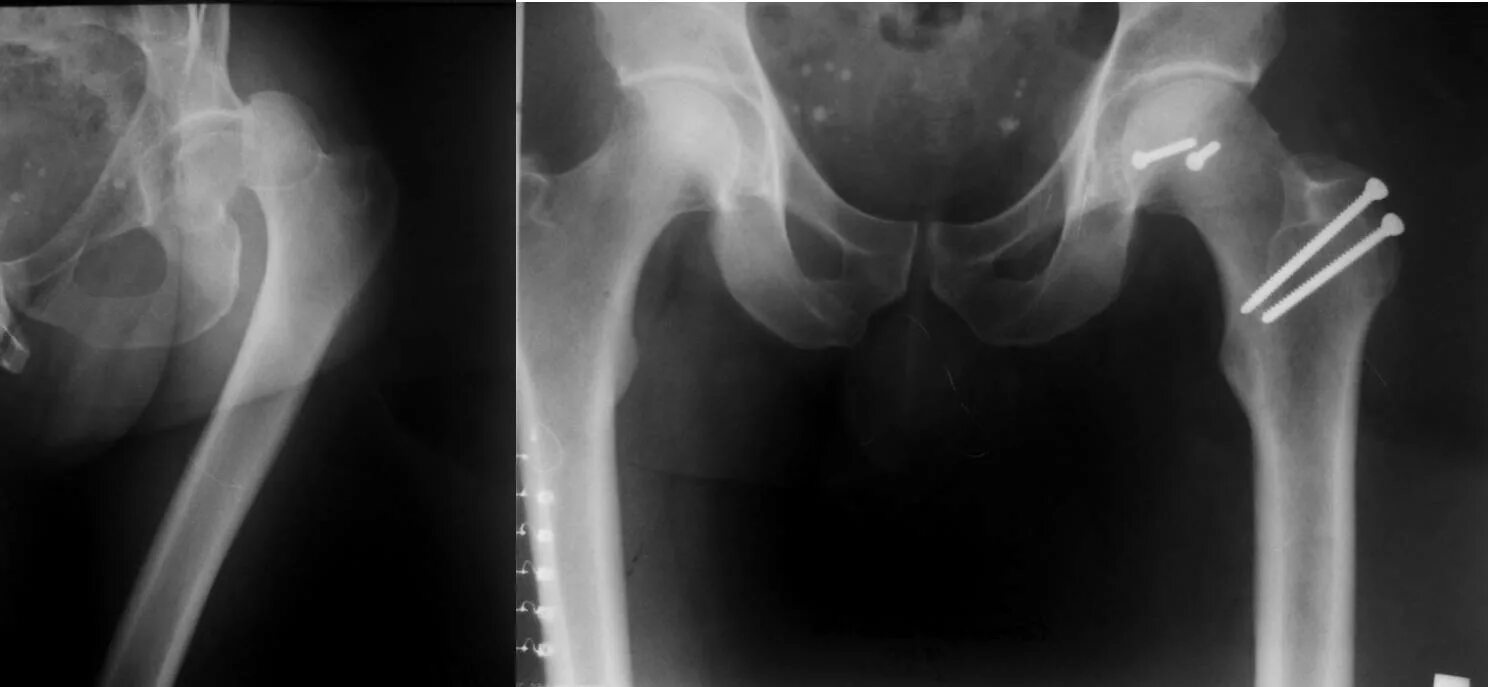 перелом бедра у старых