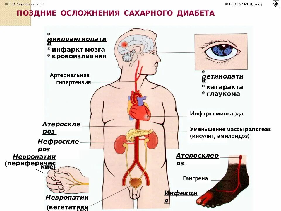 Сахарный диабет с множественными осложнениями. Осложнения сахарного диабета 2 типа. Осложнения при сахарном диабете 1 типа. Осложнения СД 1 типа и 2 типа. Осложнения от сахарного диабета 1 типа.