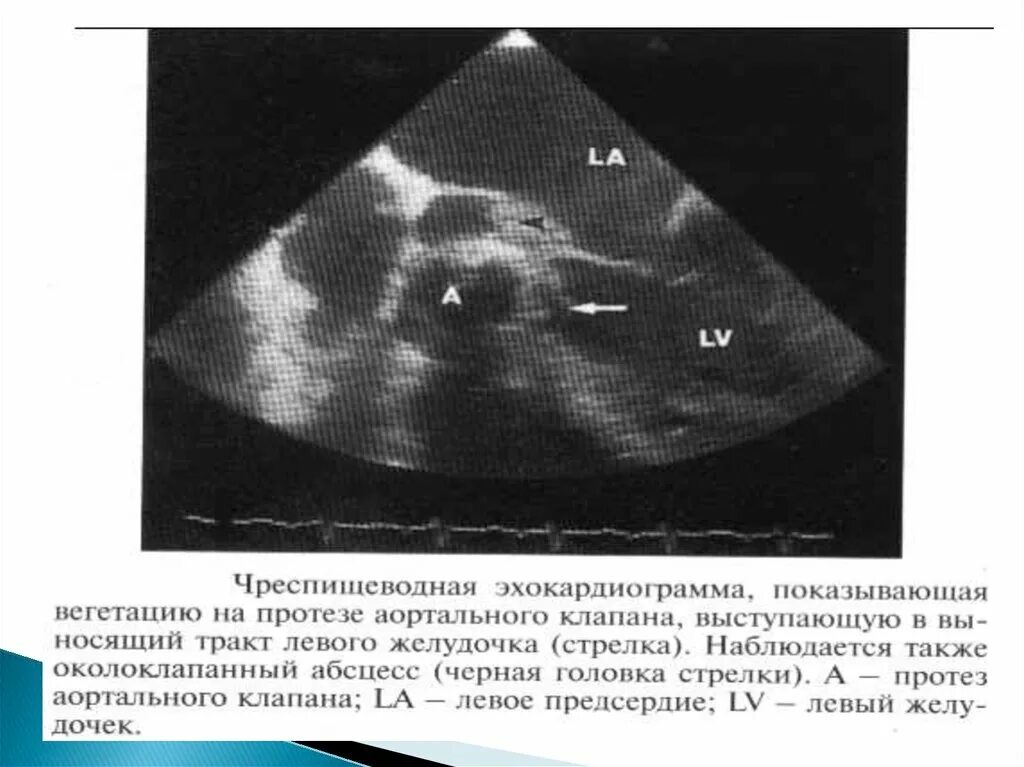 Вегетация сердца. Инфекционный эндокардит аортального клапана. Вегетации на аортальном клапане ЭХОКГ. Миокардит на ЭХОКГ. Инфекционный эндокардит Эхо.