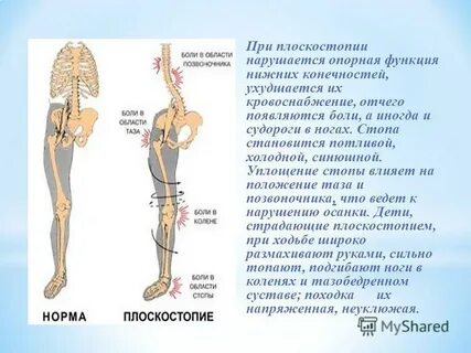 Плоскостопие сильно болят ноги