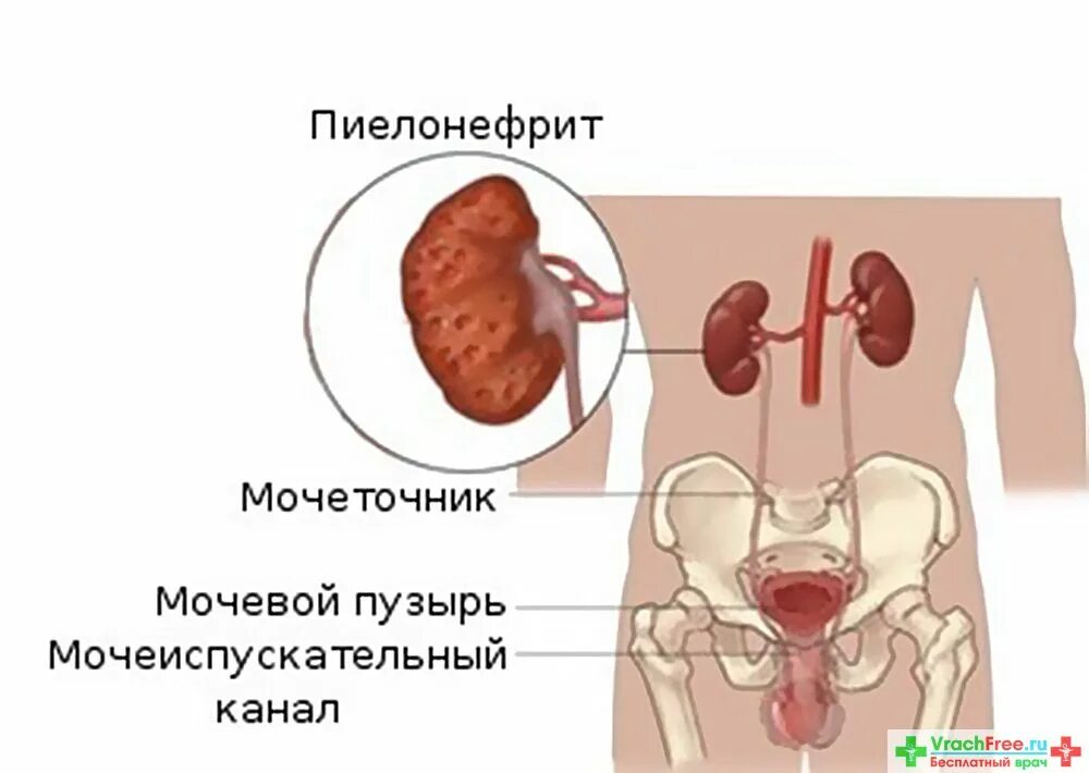 Болезнь почек пиелонефрит. Хронический пиелонефрит.