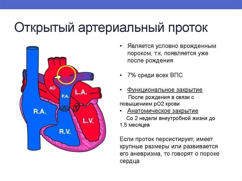 Пороки сердца боталлов проток. Врожденный порок сердца открытый артериальный проток. ВПС открытый артериальный проток у детей. Открытый артериальный проток при ВПС.