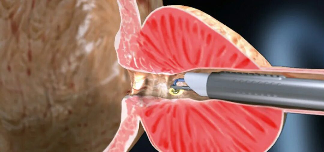восстановление после тур аденомы. лазерная энуклеация аденомы предстательной железы. восстановление после тур аденомы. восстановление после тур аденомы. восстановление после тур аденомы.