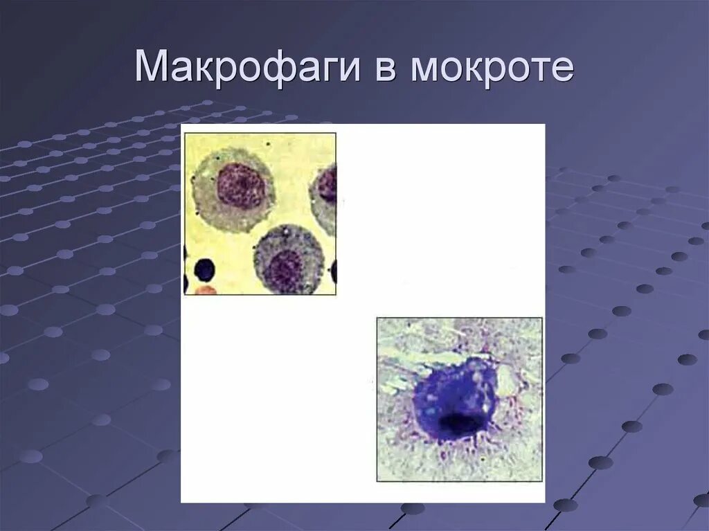 Макрофаги препарат. Макрофаги гистология. Альвеолярные макрофаги в мокроте микроскопия. Альвеолярные макрофаги в мокроте нативный препарат. Макрофаги с миелином в мокроте.