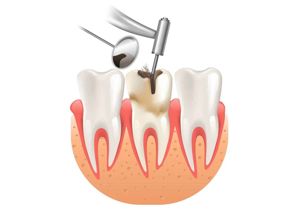 Root canal. Высверливание кариеса.