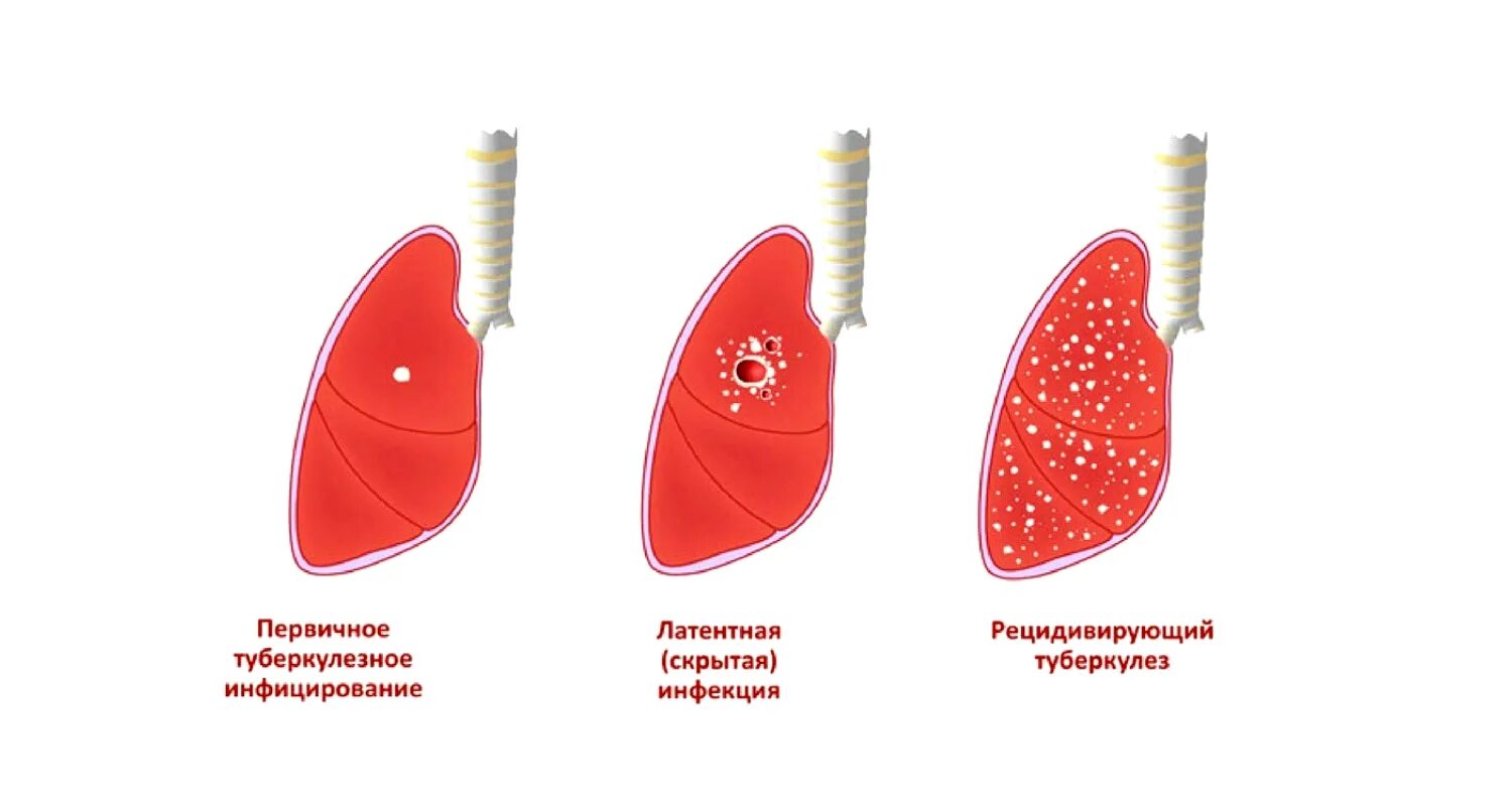 Стадии развития легких. Этапы развития туберкулезного процесса. Этапы развития туберкулеза легких фтизиатрия. Периоды развития заболевания туберкулеза. Фазы развития туберкулеза.