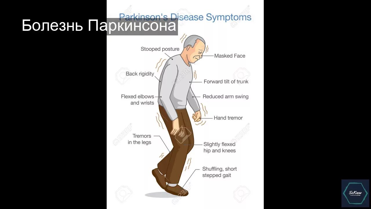 Сирилом норткотом паркинсоном. Норткот паркинсон. Шутка про альцгеймера. Анекдоты про паркинсона. Болезнь альцгеймера мем.