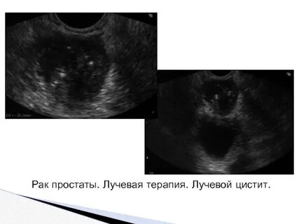 Цистит после лучевой терапии лечение