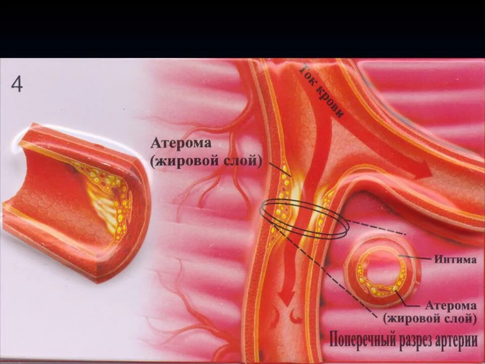 Распад сосудов. Атерома при атеросклерозе. Атерома и атеросклеротическая бляшка.