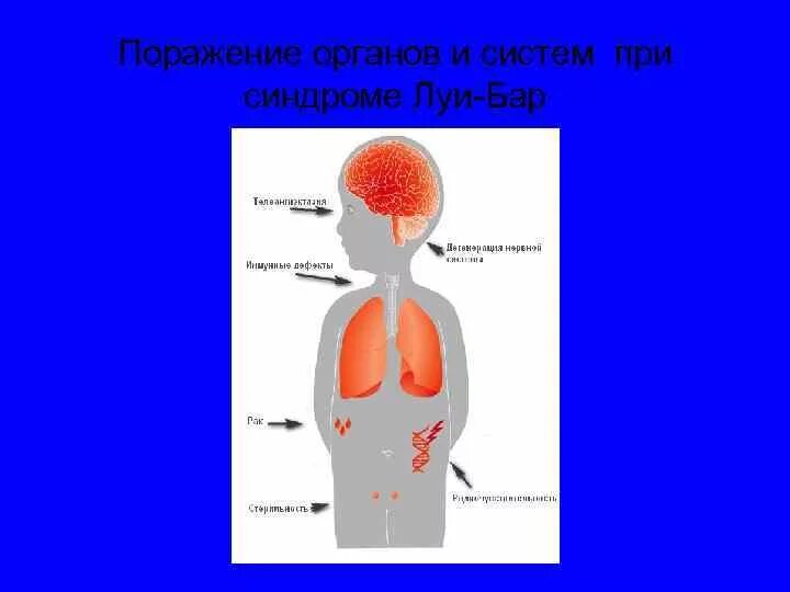 Синдром луи барра. Синдром луи барра