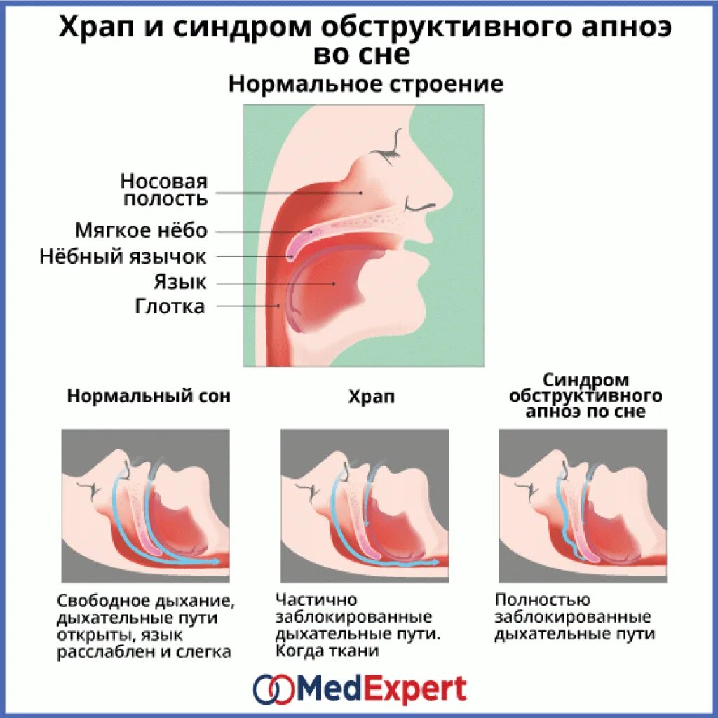 Ночью сильно храплю