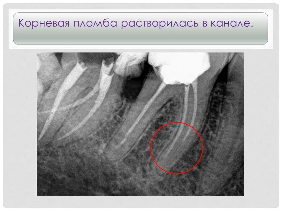 Пломбировка корневых каналов. Запломбированные корневые каналы. Неполное пломбирование корневого канала. Острый диффузный пульпит рентген. Запломбирован ли канал зуба на снимке.