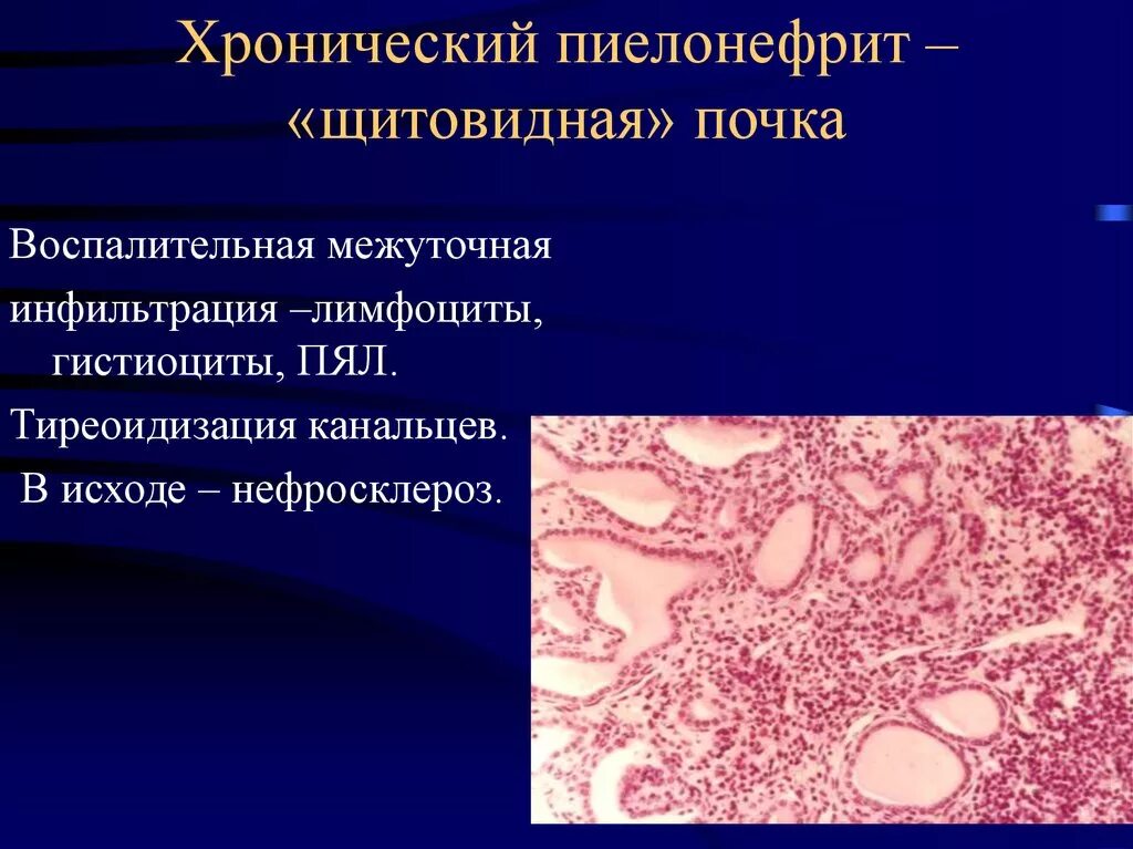 История хронического пиелонефрита. Пиелонефрит патанатомия. Пиелонефрит препарат патанатомия. Острый пиелонефрит патанатомия. Хронический пиелонефрит патанатомия.