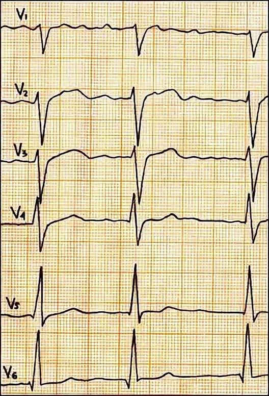 Диффузные изменения экг что это значит. Диффузные изменения миокарда левого желудочка. Диффузные изменения миокарда левого желудочка на ЭКГ. Синдром диффузных изменений миокарда. ЭКГ при миокардиодистрофии.