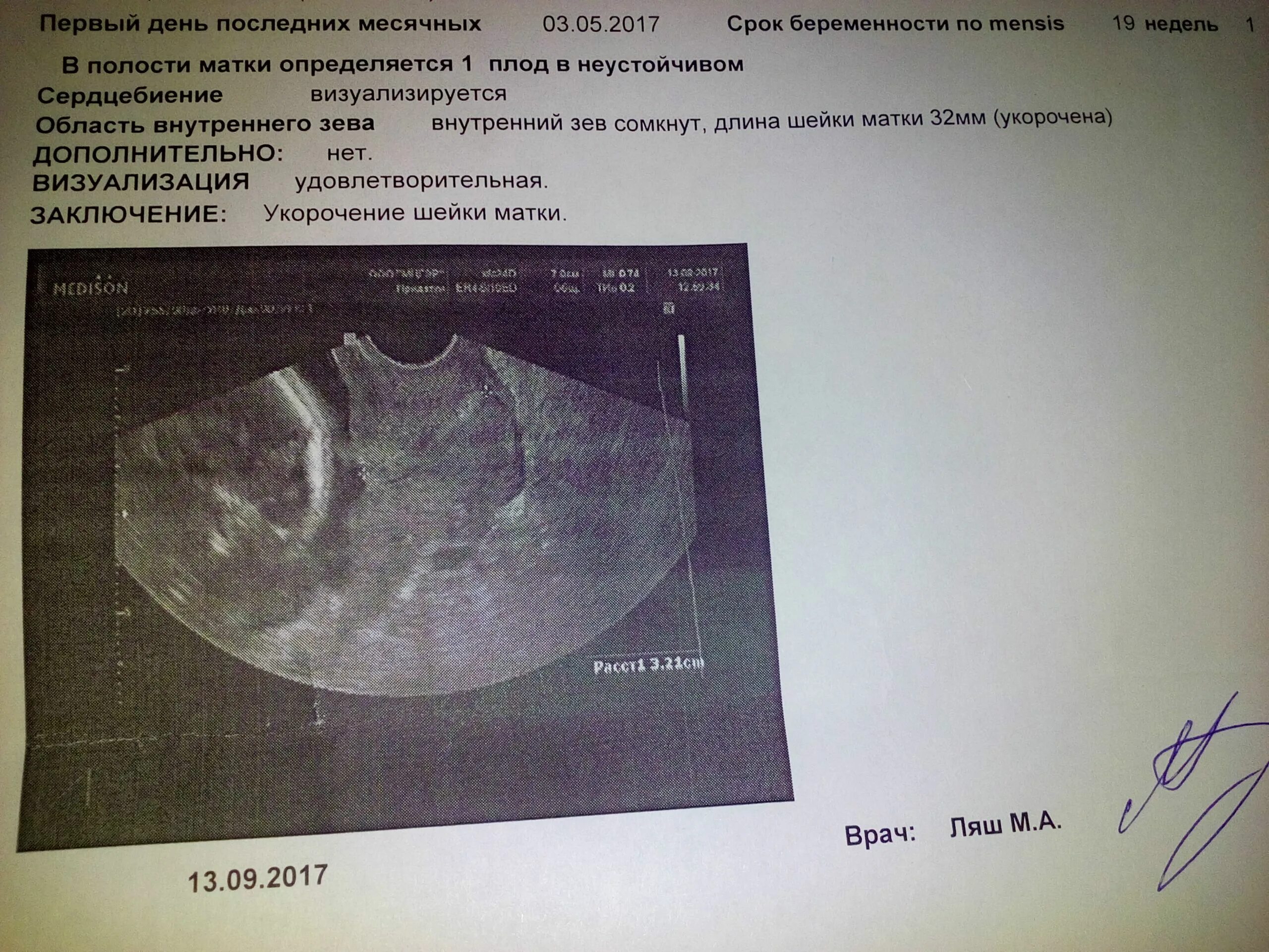 Матка 37 мм. Цервикометрия заключение УЗИ. УЗИ шейки матки цервикометрия. Цервикометрия по неделям беременности. Цервикометрия при беременности.