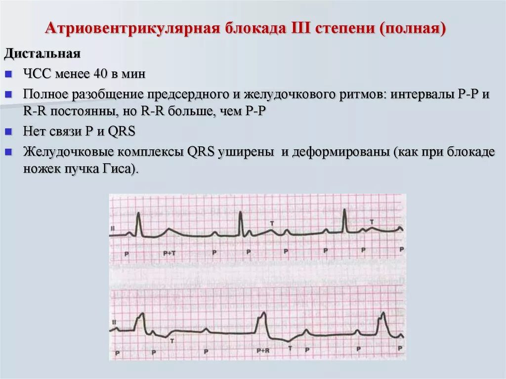 Давление блокада. ЭКГ признаки полной атриовентрикулярной блокады. Полная АВ блокада 3 степени ЭКГ. Полная атриовентрикулярная блокада 3 степени на ЭКГ. ЭКГ при АВ блокаде 3 степени.