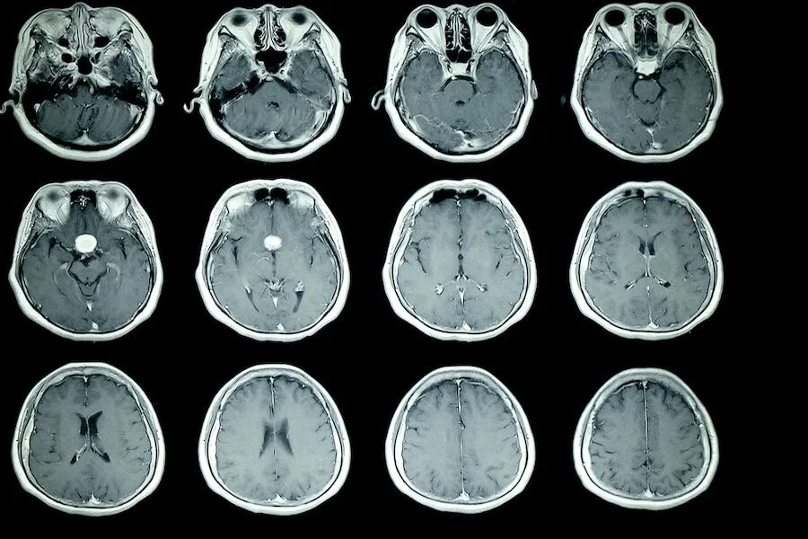 Опухоль мозга у собак. Опухоль головного мозга снимок мрт. Глиобластома головного мозга на кт и мрт. Доброкачественная опухоль головного мозга мрт.