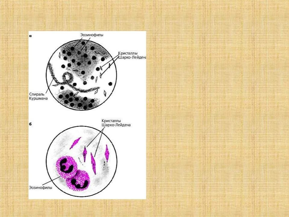 Куршмана кристаллы шарко лейдена. Спирали Куршмана и Кристаллы Шарко-Лейдена. Спирали Куршмана и Кристаллы Шарко-Лейдена в мокроте. Спирали Куршмана, Кристаллы Шарко-Лейдена, эозинофилы. Кристаллы Шарко-Лейдена и спирали Кургана в мокроте.