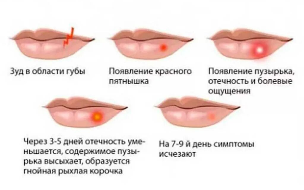 Почему утром губы. Язвочки на губе герпес. Первичный лабиальный герпес. Простудный герпес на губах.