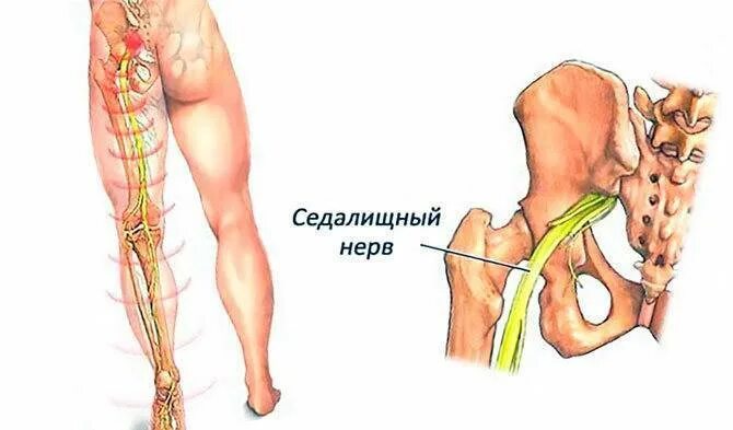 Блокада при защемлении седалищного нерва. Ишиас седалищного нерва. Защемление седалищного нерва блокада. Ишиас - защемление седалищного нерва. Невропатия седалищного нерва клиника.