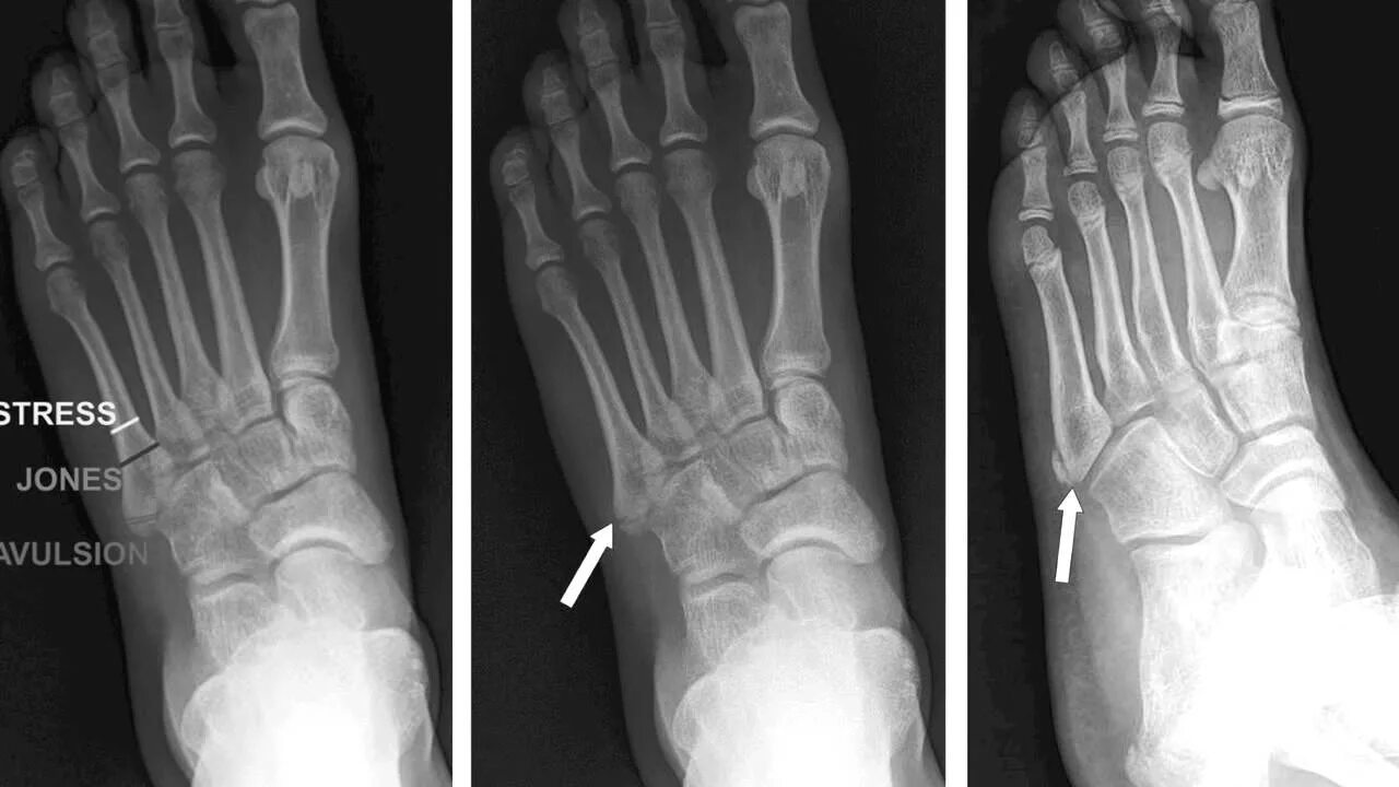 Трещина плюсневой. Перелом 5 плюсневой кости. Зона роста 5 плюсневой кости. Рентген перелома 5 плюсневой кости. Перелом 2 плюсневой кости гипс.