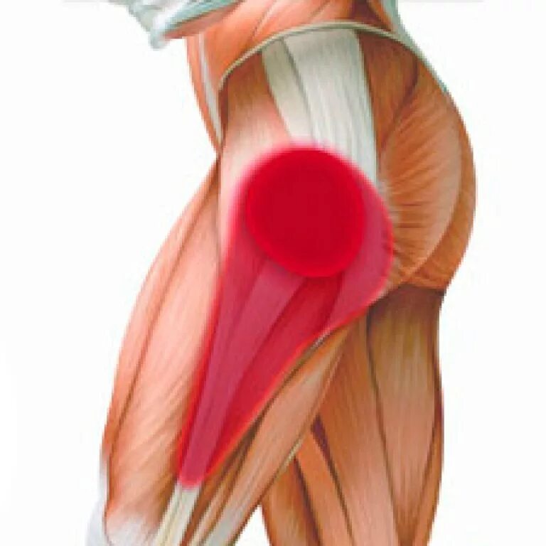 Лечение ноет нога от бедра. Бурсит трохантерит тазобедренного сустава. Трохантерит тазобедренного сустава . Сухожилия. Трохантерит тазобедренного сустава мышцы. Тендовагинит сухожилий тазобедренного сустава.