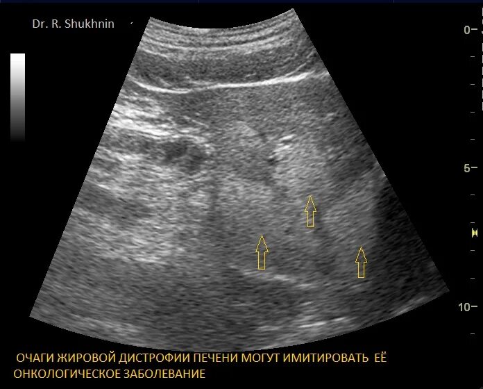 Очаговый жировой гепатоз на УЗИ. Жировой гепатоз очаговая форма на УЗИ. Диффузные изменения печени жировой гепатоз что это