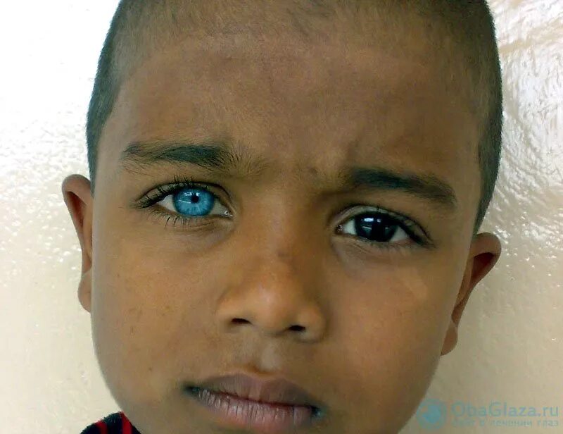 Центральная гетерохромия зеленый Карий. Люди мюс разными глазами. Разноцветные глаза. Как называется болезнь когда разный цвет глаз