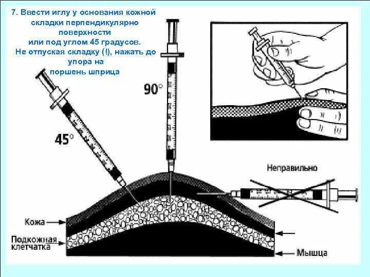 Угол введения при подкожной инъекции. Игла при подкожной инъекции ВВО. Угол введения подкожной инъекции в градусах. Подкожная инъекция под углом 45.