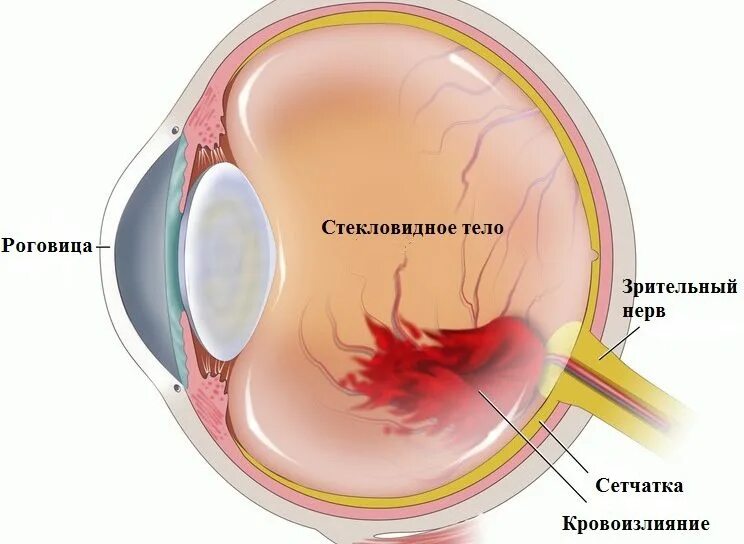 Гемофтальм мкб 10. Субконъюнктивальная гематома. Кровоизлияние в сетчатку. Кровоизлияние в стекловидное тело. Кровоизлияние в стекло Видное телот.