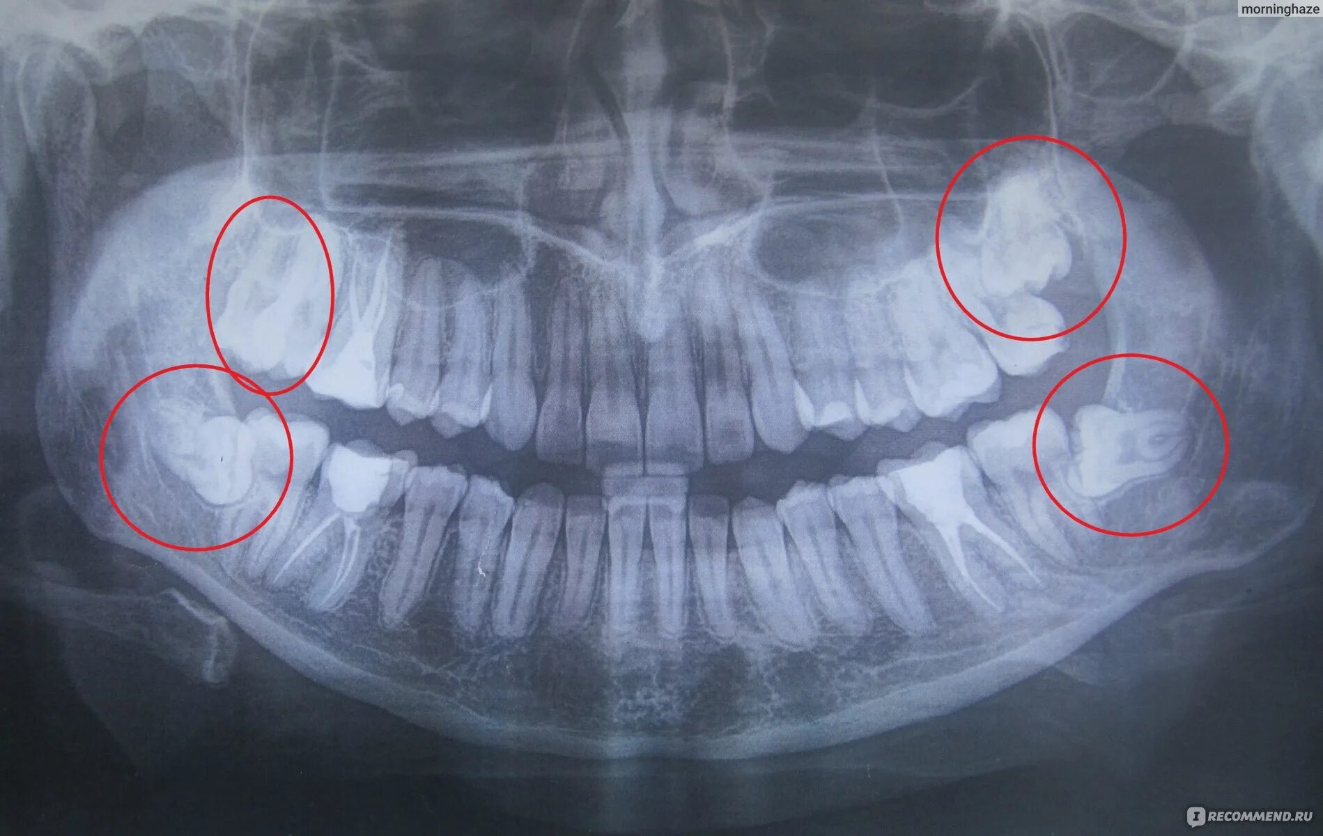 Лечат 8 зуб. Ретинированный зуб рентген. Ретинированный дистопированный зуб мудрости.