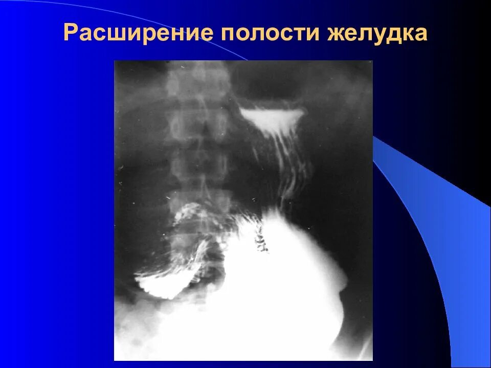 Наполнение желудка. Лучевая диагностика органов жкт. дефект наполнения желудка. методы лучевой диагностики желудка.