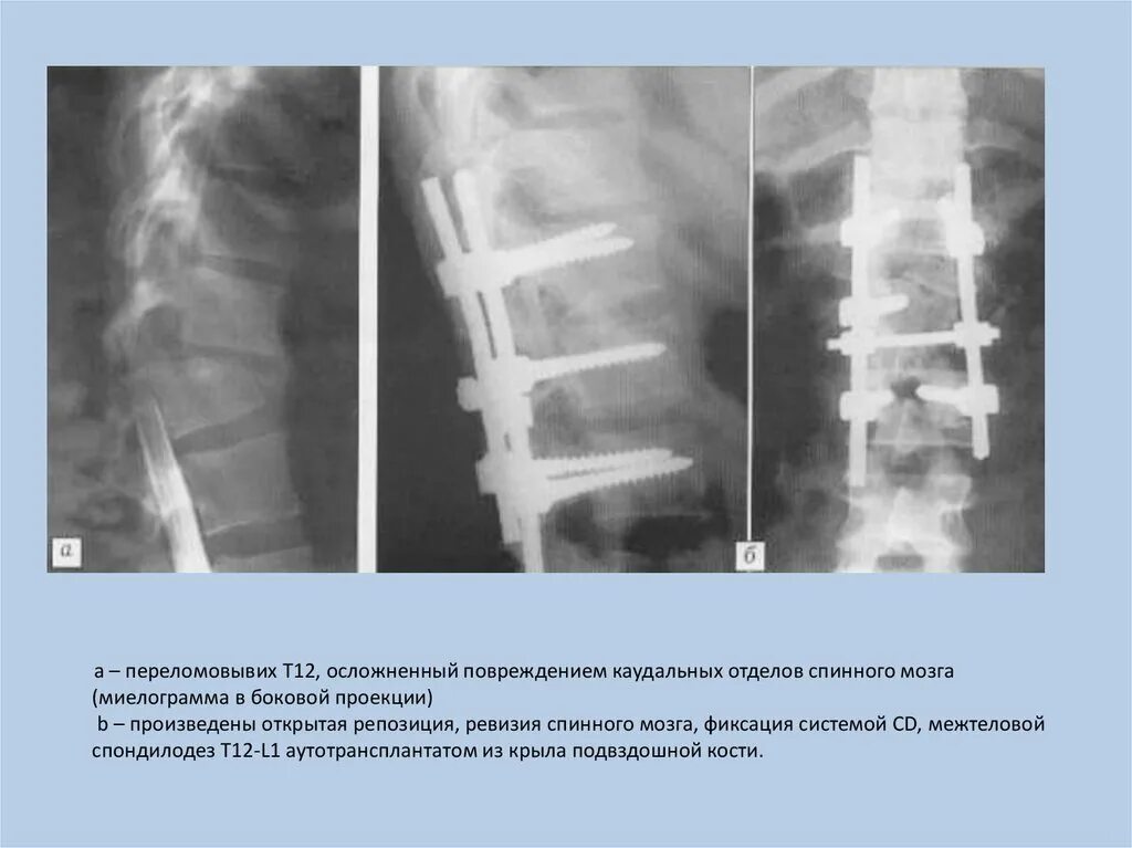 Операция на грудном отделе позвоночника. Перелом позвоночника остеосинтез рентген. Спондилодез l5 s1 Кейджем. Спондилодез поясничного отдела позвоночника рентген. Транспедикулярная фиксация позвоночника рентген.