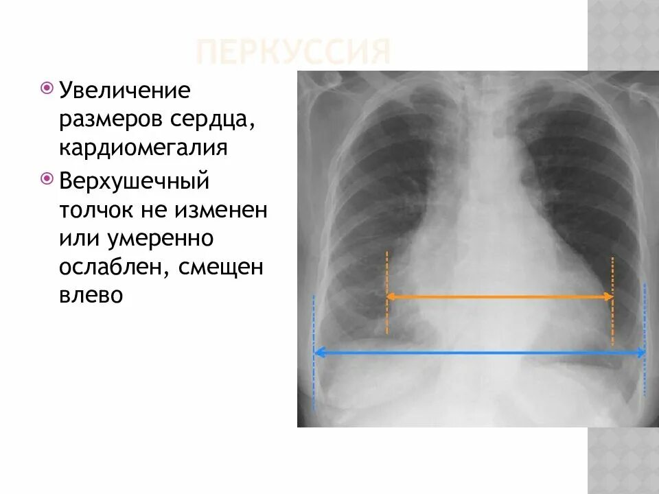 Что значит сердце увеличено влево