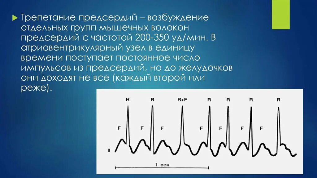 Частота предсердий. Трепетание предсердий с частотой 200. частота выработки импульса в желудочках. частота атриовентрикулярного узла. импульсы в желудочках в норме вырабатываются с частотой.